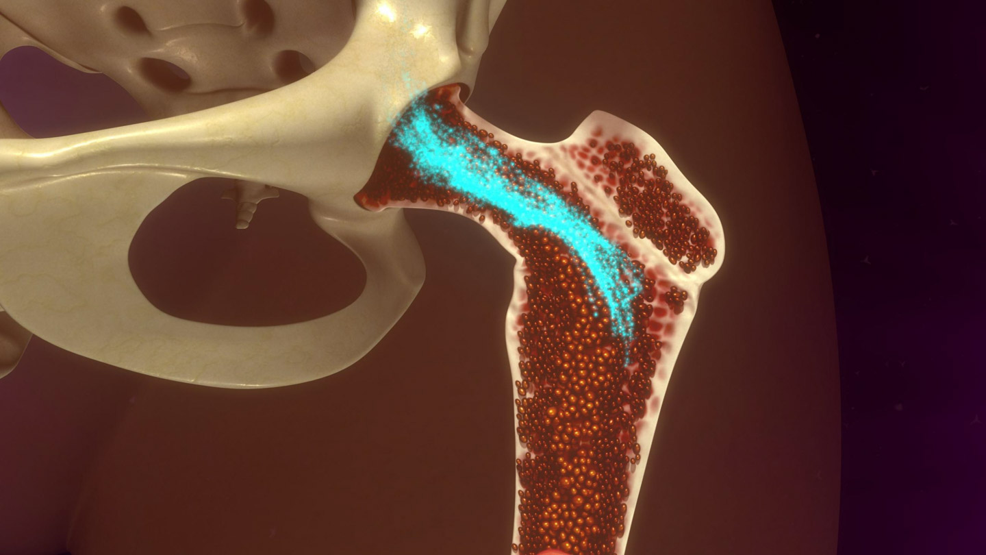 illustration of femur highlighting bone marrow