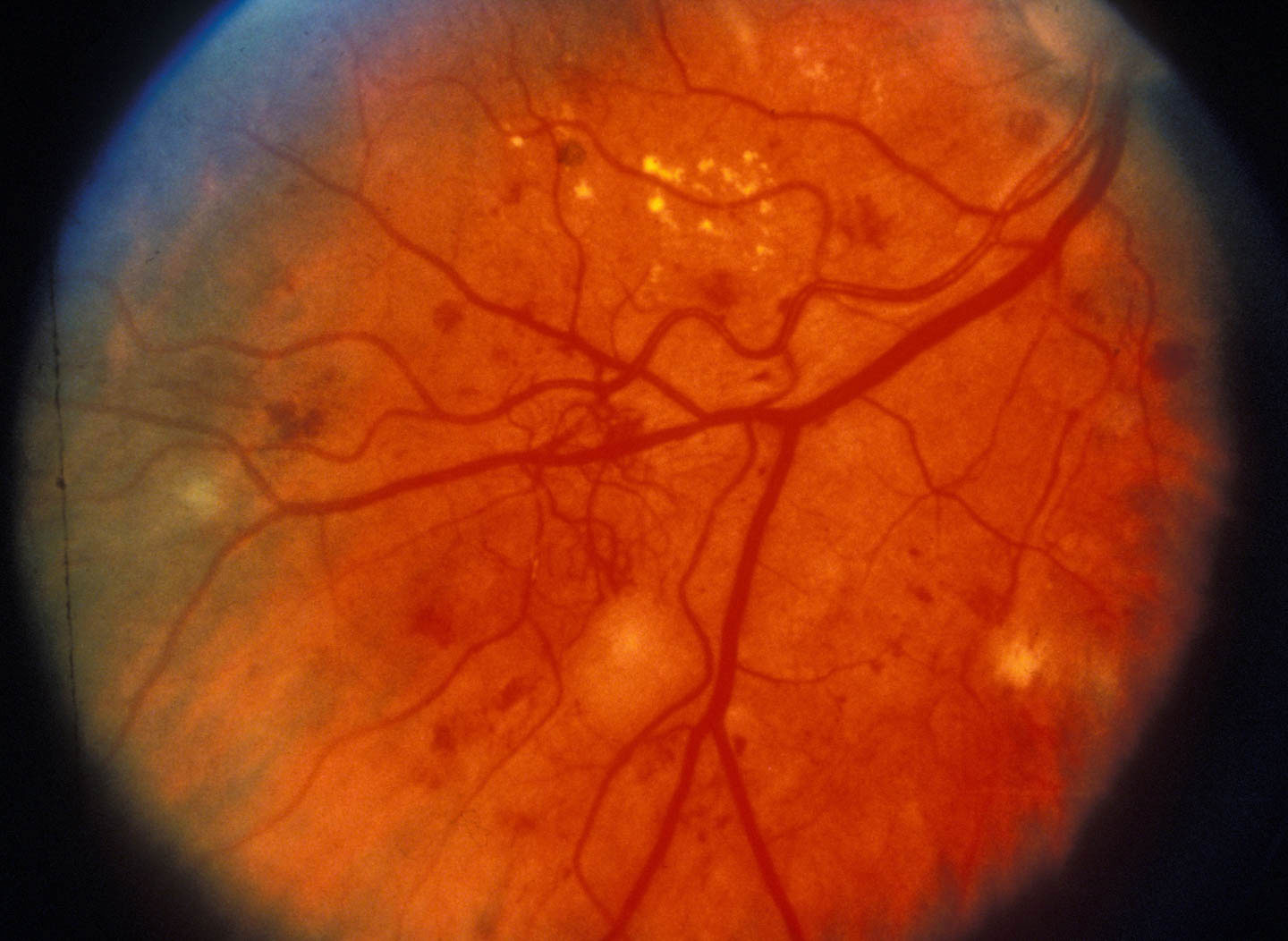 Abnormal blood vessels in patient with diabetic retinopathy