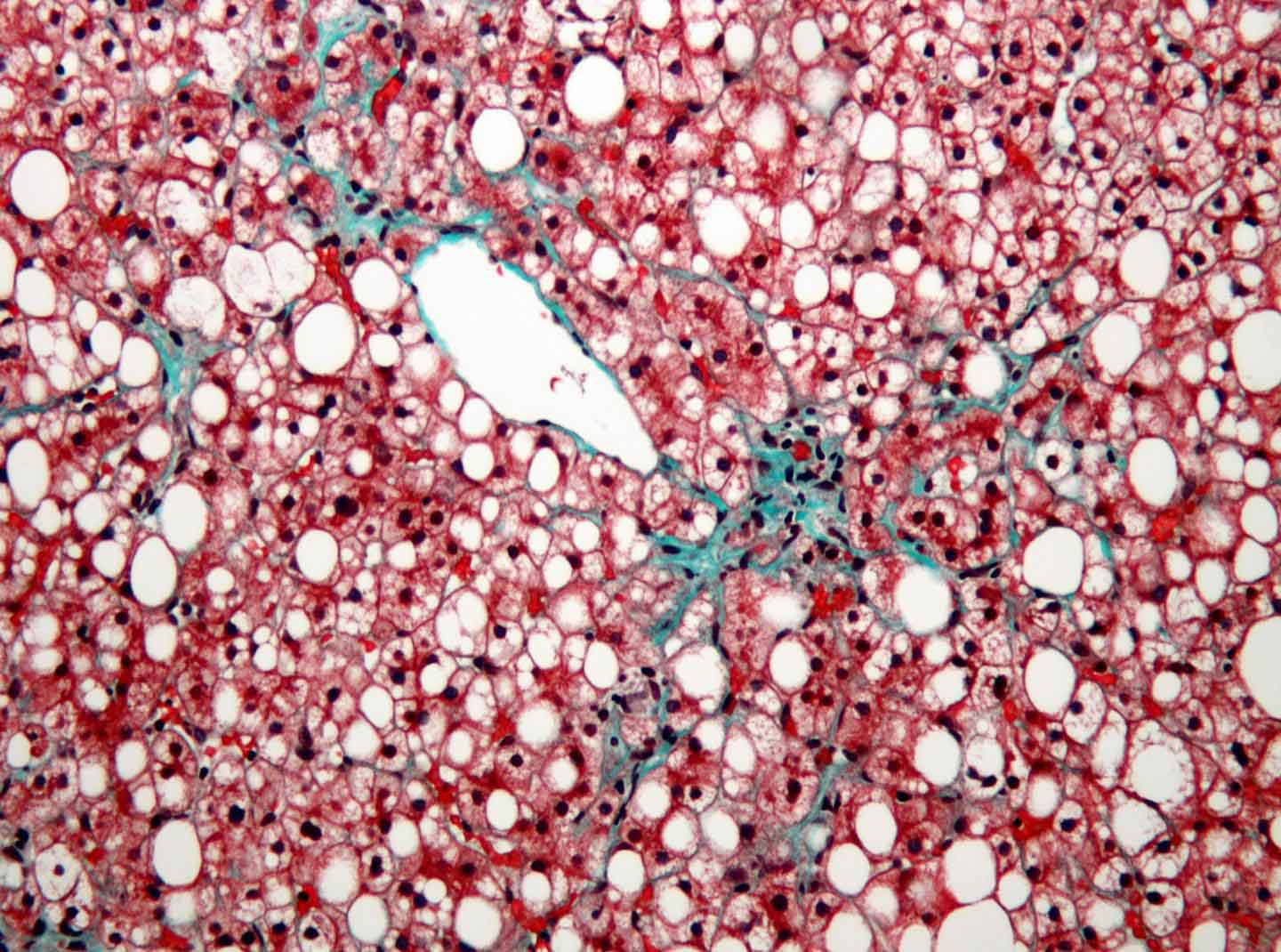 Fatty liver tissue (trichrome stain)