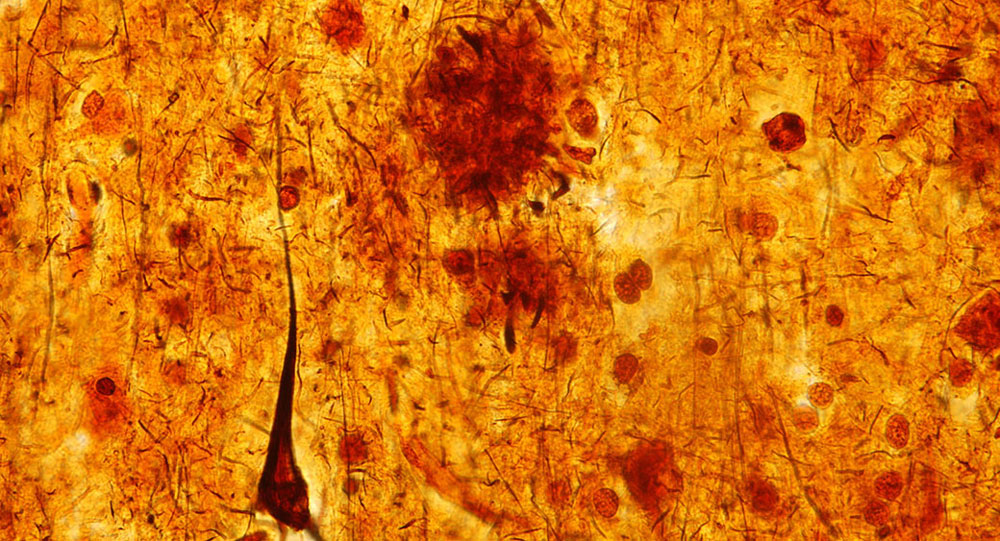 Silver-stained brain tissue showing senile plaque