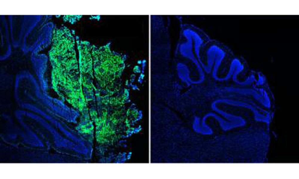 Left shows medulloblastoma tumor (green) from untreated mouse. Right shows brain tissue from mouse treated with bFGF lacks tumor growth.