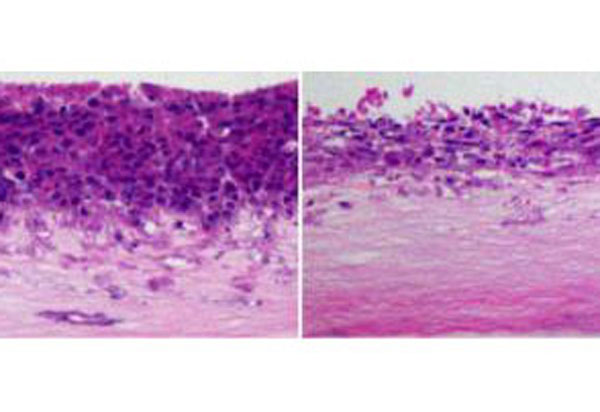 Prostate cancer cells expressing a mutant form of c-Myc that cannot be altered by PKCzeta (left) are more aggressive and more invasive than prostate cancer cells in which PKCzeta is able to keep tabs on c-Myc (right).