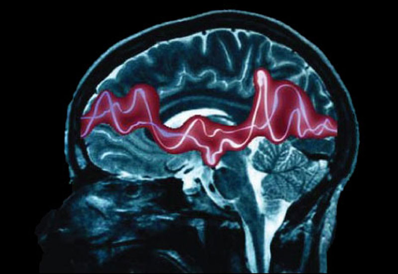 Epilepsy is a brain disorder causing seizures that disturb brain activity