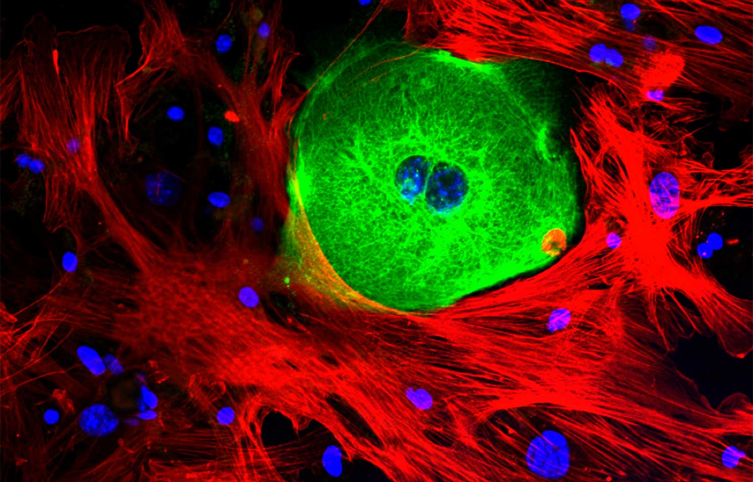 A cancer cell (green) surrounded by structure-supporting stroma cells (red). DNA shown in blue. 