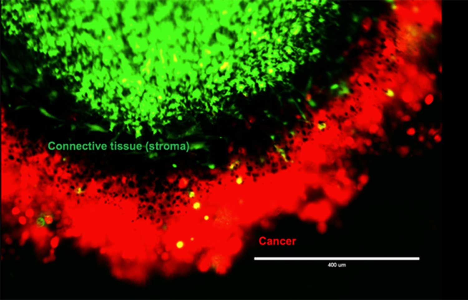 Connective tissue cells (stroma) and cancer cells interact 