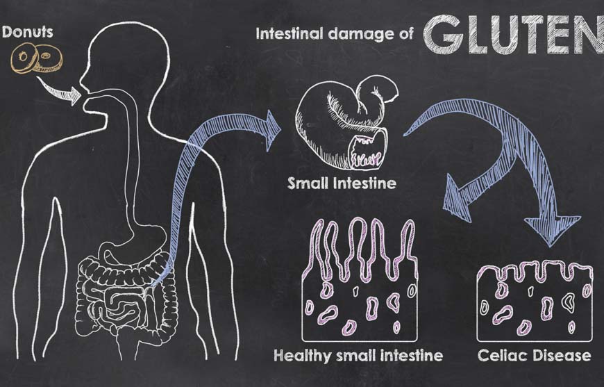 intestinal damage of gluten