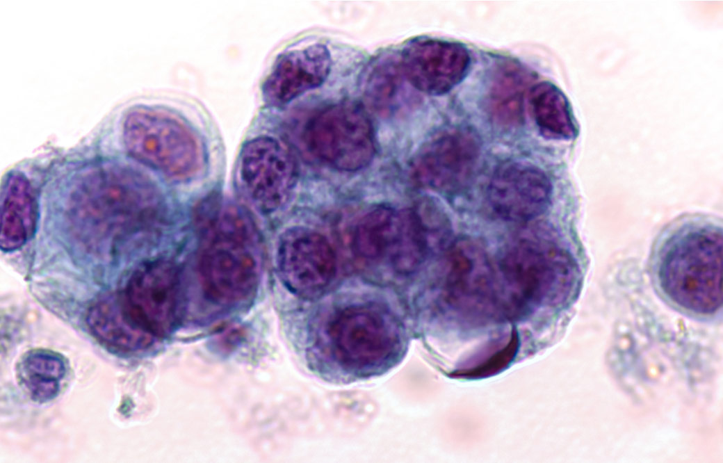 Tumor cells