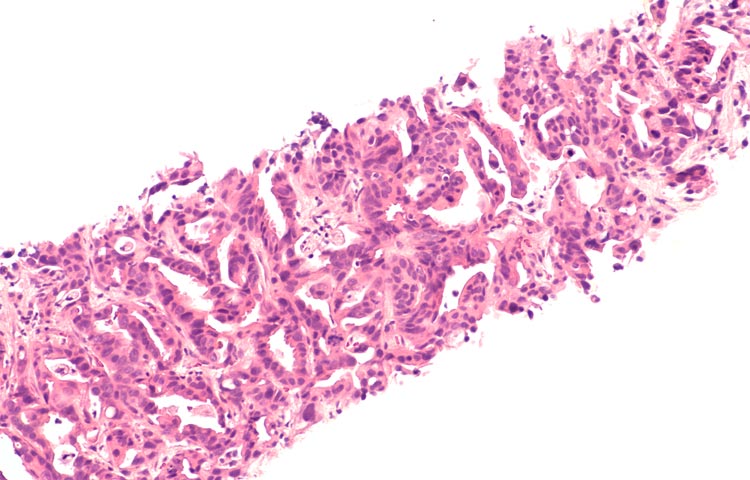 Microscopic photograph of a core biopsy of liver, showing histology of metastatic pancreatic adenocarcinoma (cancer of pancreas).