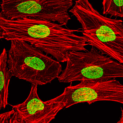 Melanoma cells