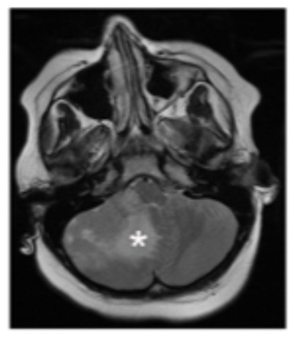 drug screen metastatic medulloblastoma