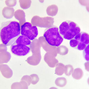 Acute myeloid leukemia (AML) cancer cells viewed under a microscope