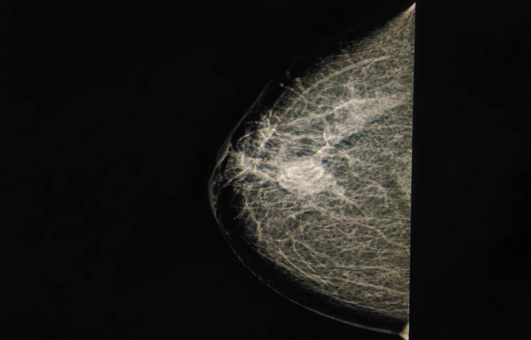 Noise and artifacts image: MAMMOGRAM Medical image showing CA right breast 3 cm fluid collection at MUQ ,near nipple right breast is noted and this may be seroma