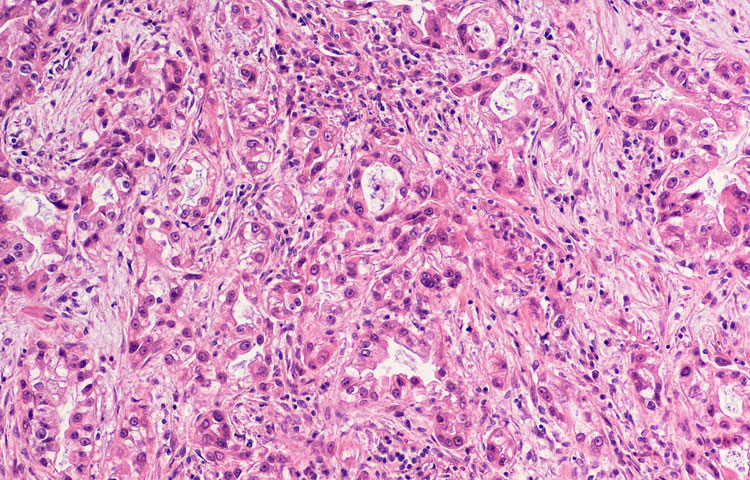 Photomicrograph of pancreatic adenocarcinoma, an invasive malignant tumor associated with a poor prognosis