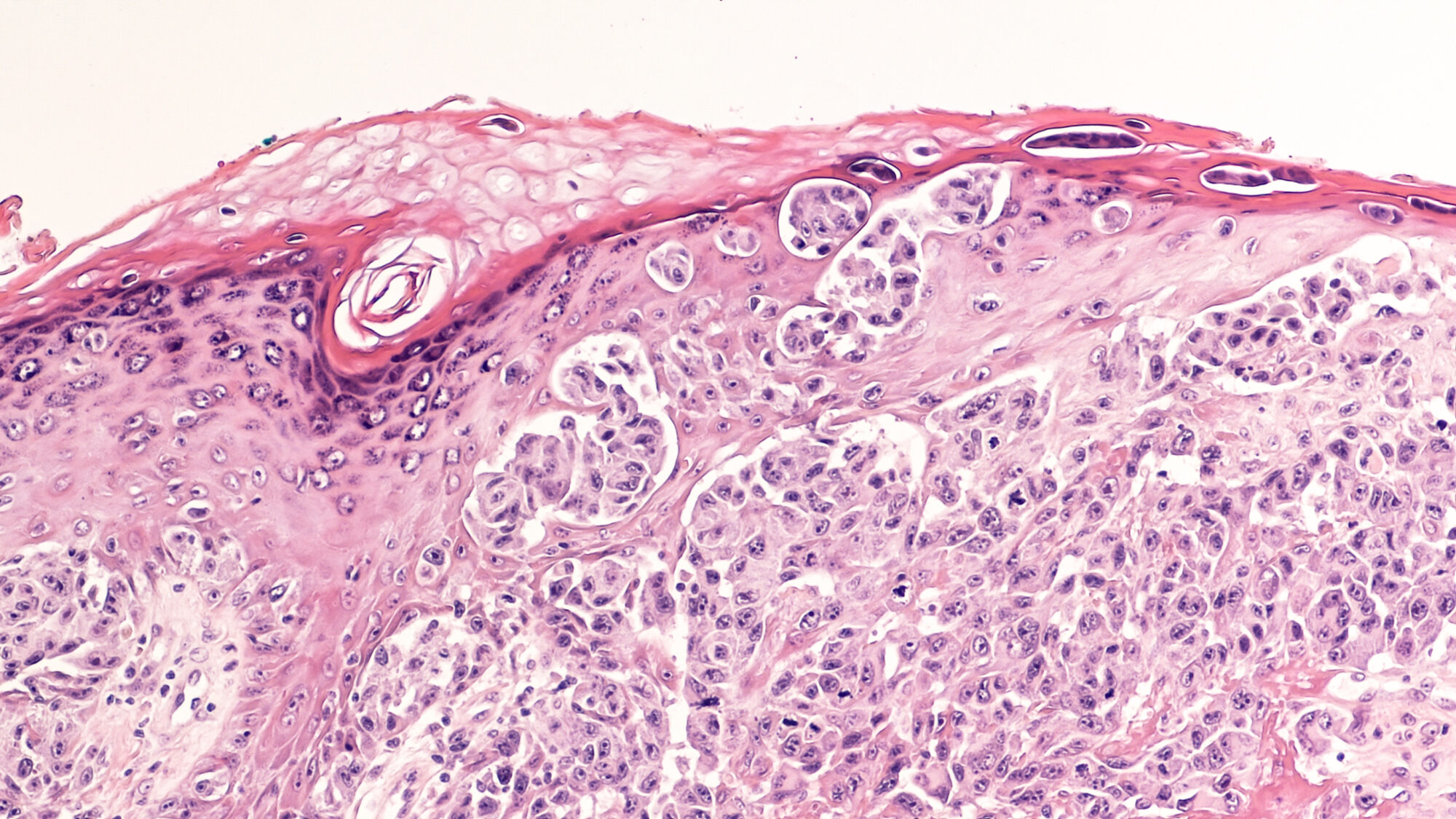 Picture of sun damaged skin biopsy