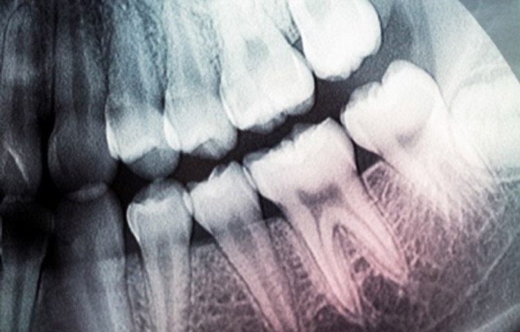 xray image of teeth