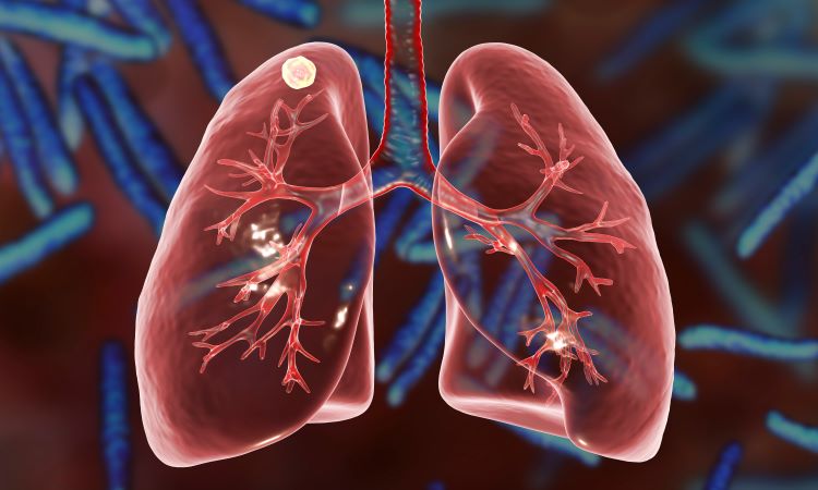 Illustration of a tuberculosis-infected lung against a backdrop of tuberculosis bacteria 