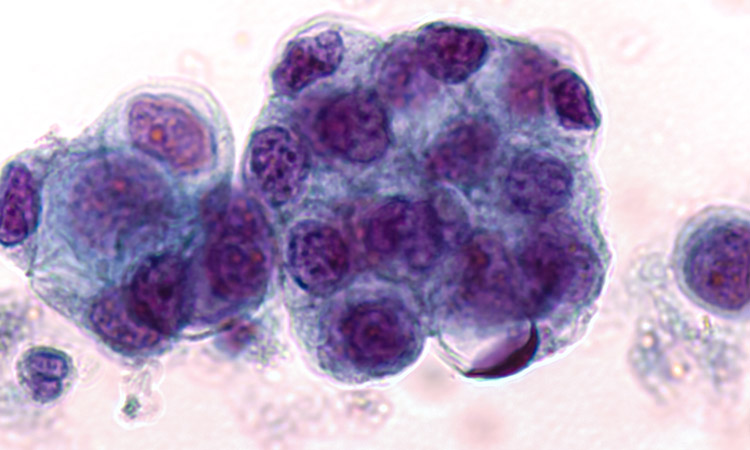 Malignant fluid cytology; Malignant cells of adenocarcinoma may spread to fluid of pleural or peritoneal cavity in cancer from the pancreas or other sites