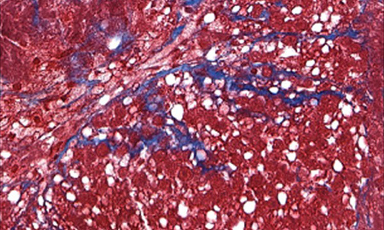 A stained micrograph of 3D primary human liver cell tissue modeling MASH. Areas of fibrosis are indicated in blue. Image courtesy of Viscient Biosciences.