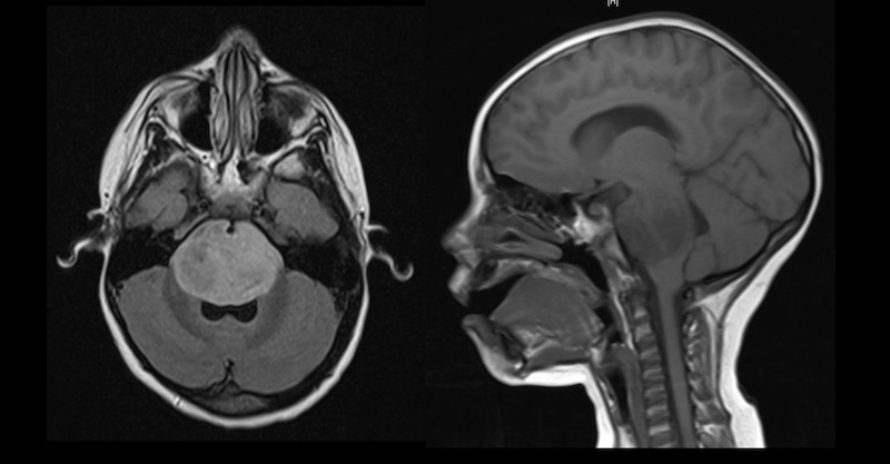 Magnetic resonance images of a brainstem glioma in a 4-year-old patient. Image courtesy of Wikimedia Commons.