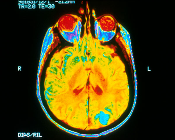 A colorized magnetic resonance image of a patient with brain cancer depicts a glioblastoma or tumor (blue) metastasizing in the occipital lobe (bottom of MRI). Image courtesy of National Cancer Institute.