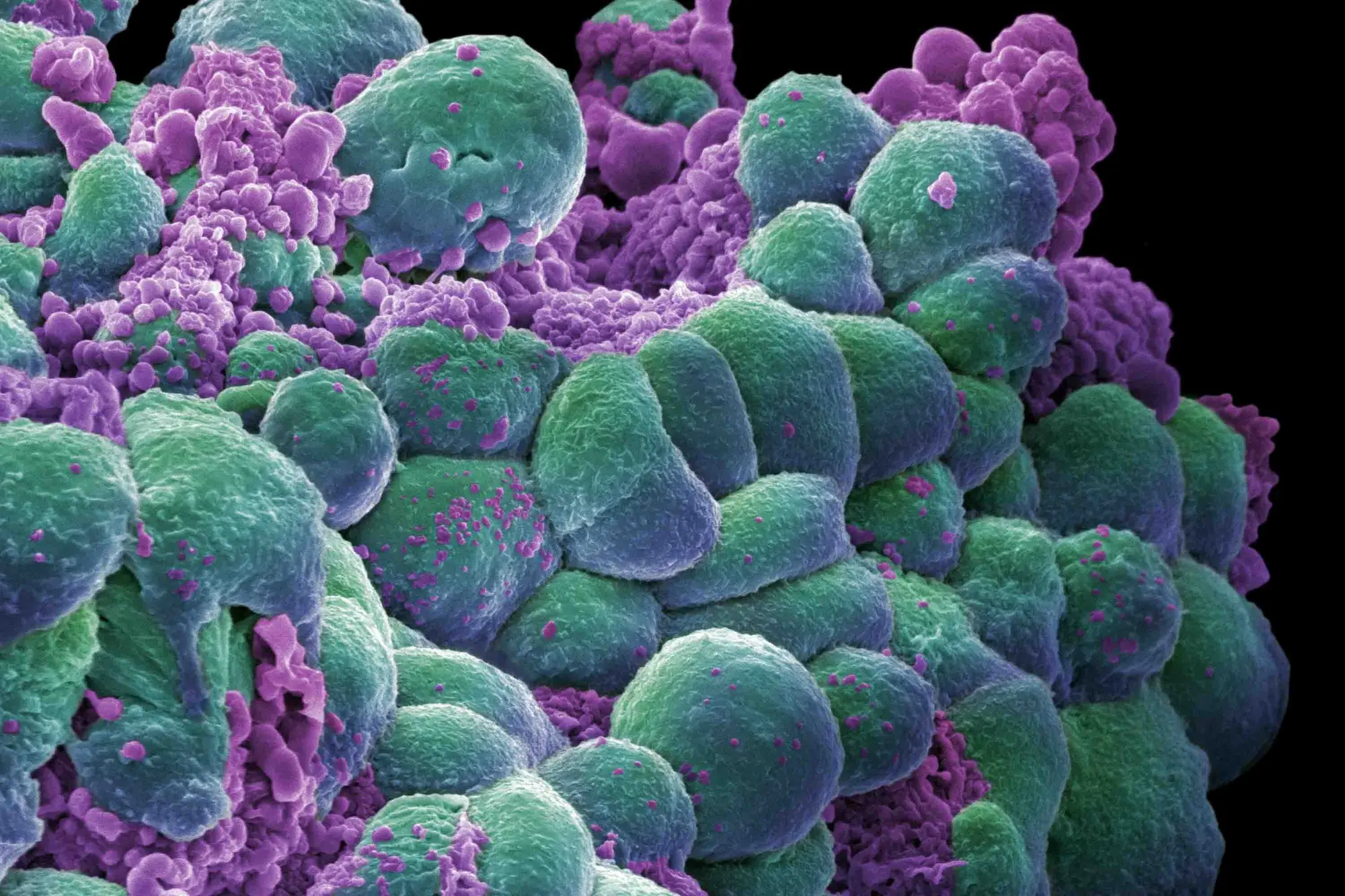 breast cancer cells