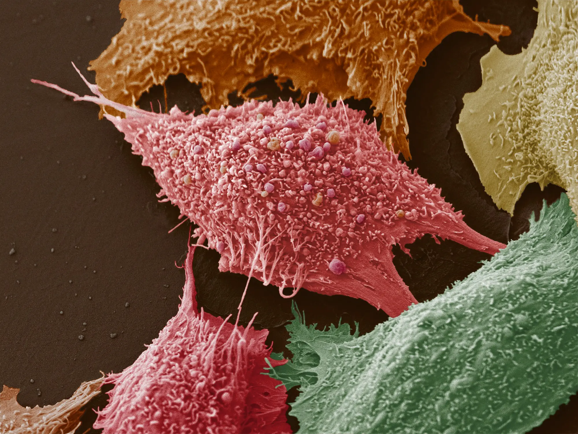 cancer cells