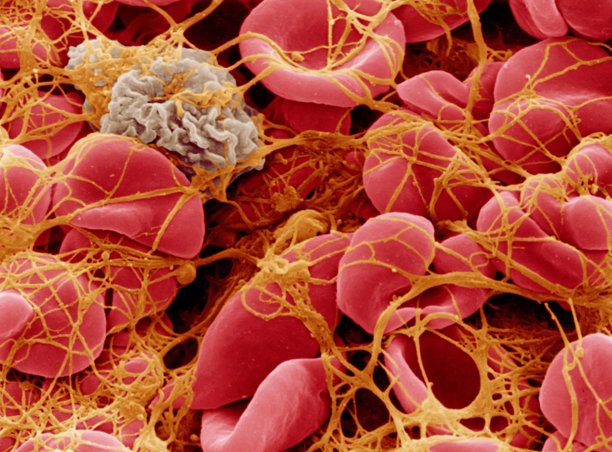 red blood cell clot