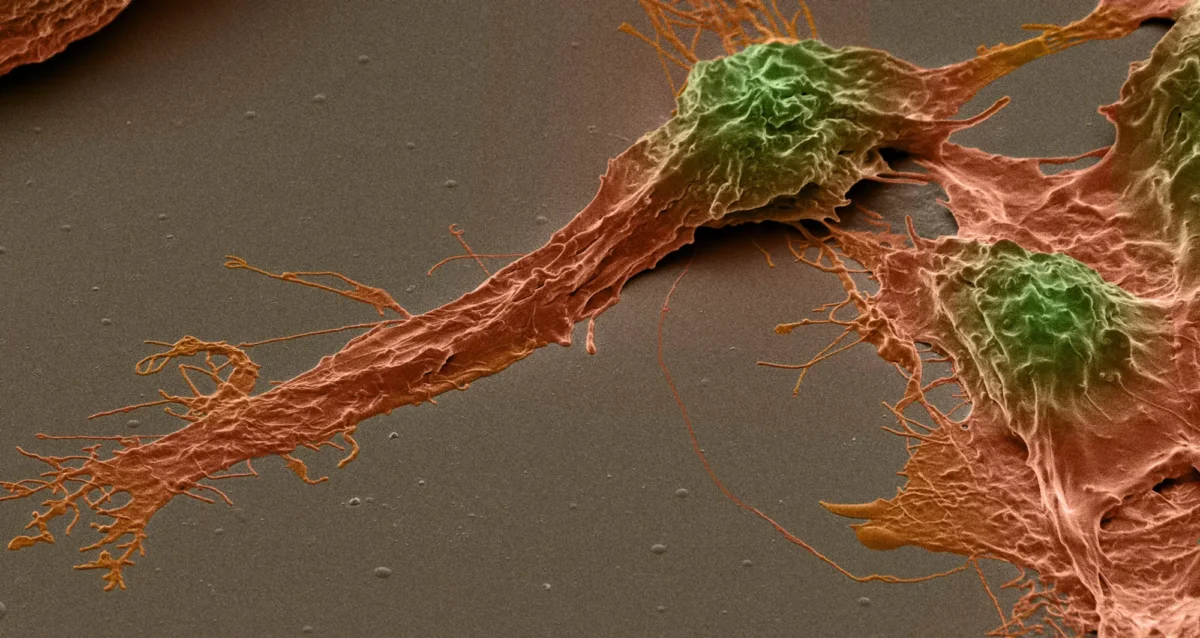 colorized scanning electron micrograph of a human brain cancer stem cell