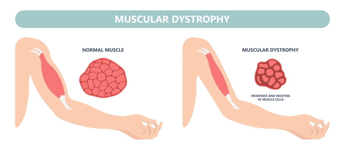 illustration of muscular dystrophy. Courtesy of Shutterstock