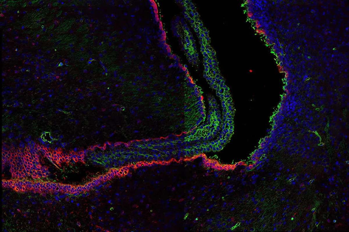 When there is too much cerebrospinal fluid in the brain, the fluid-filled ventricles depicted in black expand. This neurological disorder is known as hydrocephaly. The blood vessels that make cerebrospinal fluid are shown in blue, and they are lined with cells displayed in red that possess green fibers responsible for moving the fluid around the brain. Scientists at Sanford Burnham Prebys are studying how fats released in cerebrospinal fluid due to severe bleeding may lead to issues with brain development, including hydrocephaly. Image courtesy of Nicole Lummis and Jerold Chun’s lab.