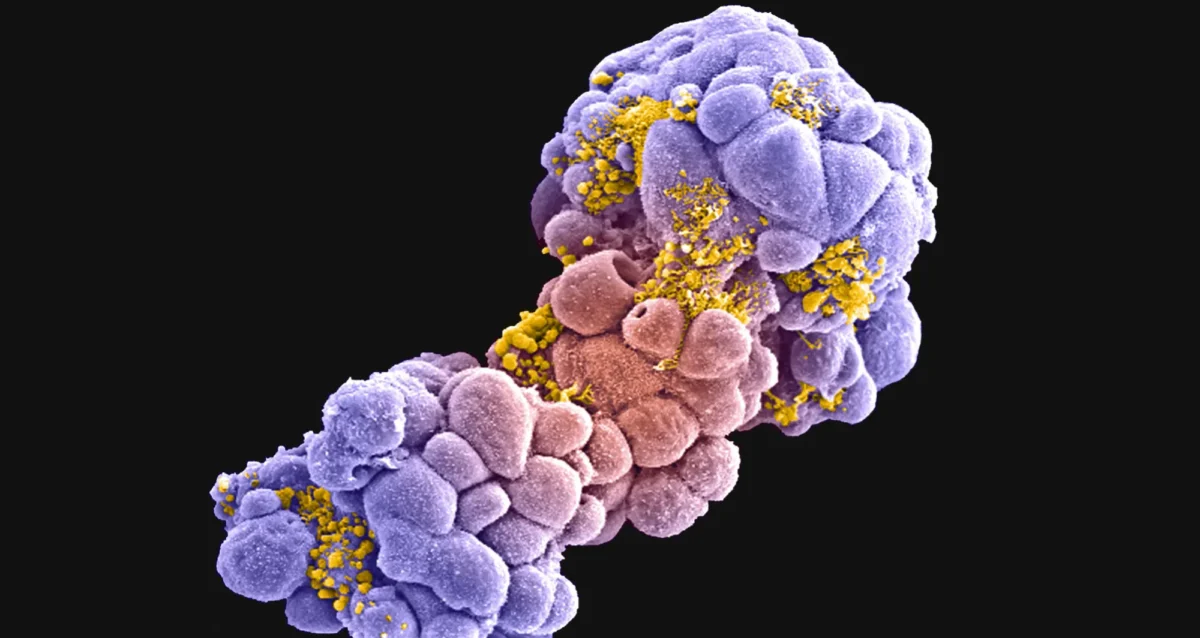 false-colored scanning electron micrograph of a breast tumor spheroid