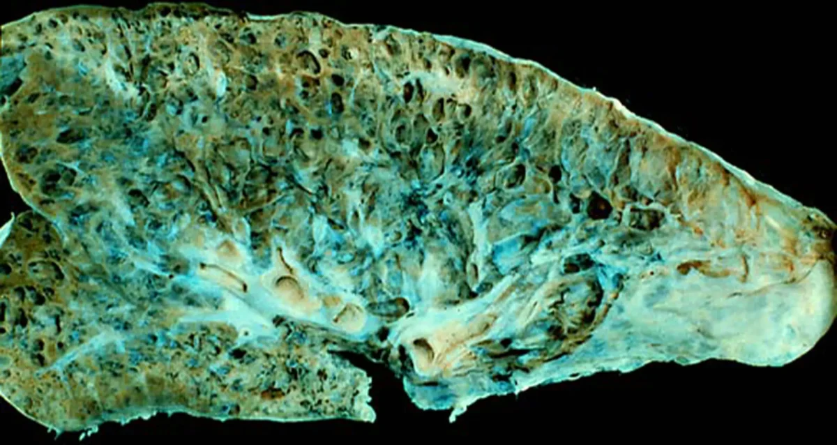 Ektachrome transparency of post-mortem, end-stage pulmonary fibrosis