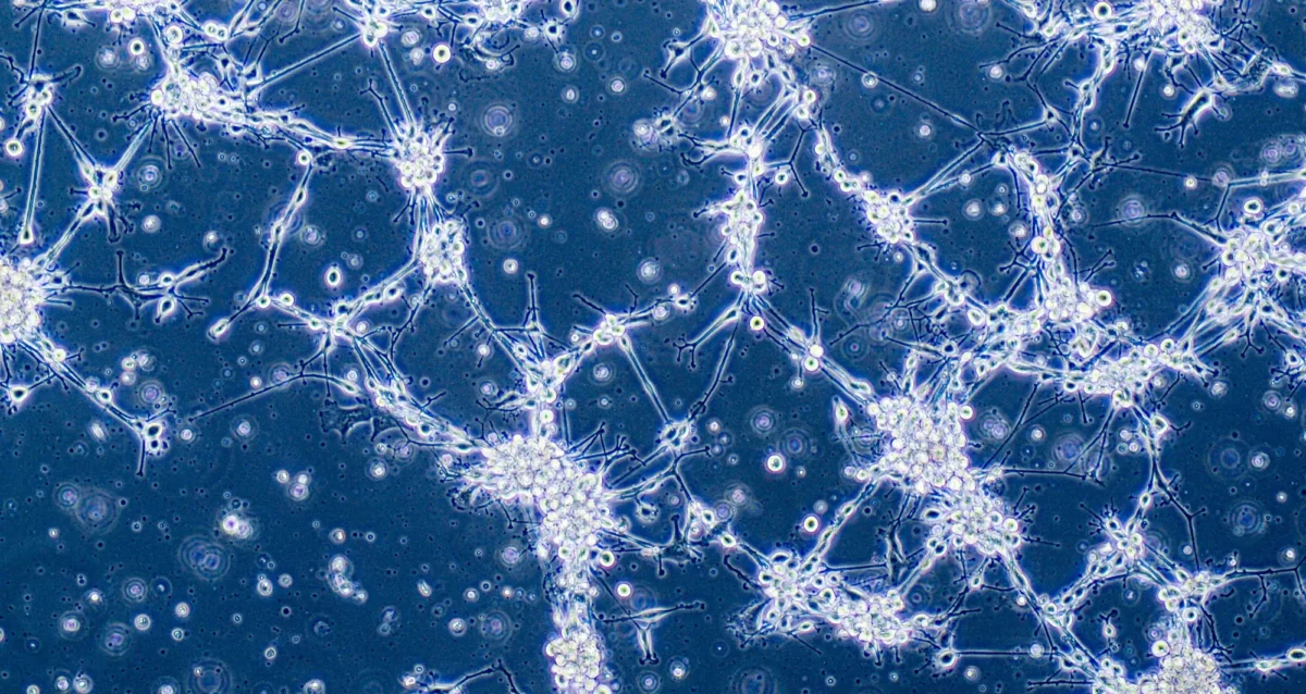 Glioblastoma brain cancer cells under microscope. Image credit: Anna Durinikova/Shutterstock