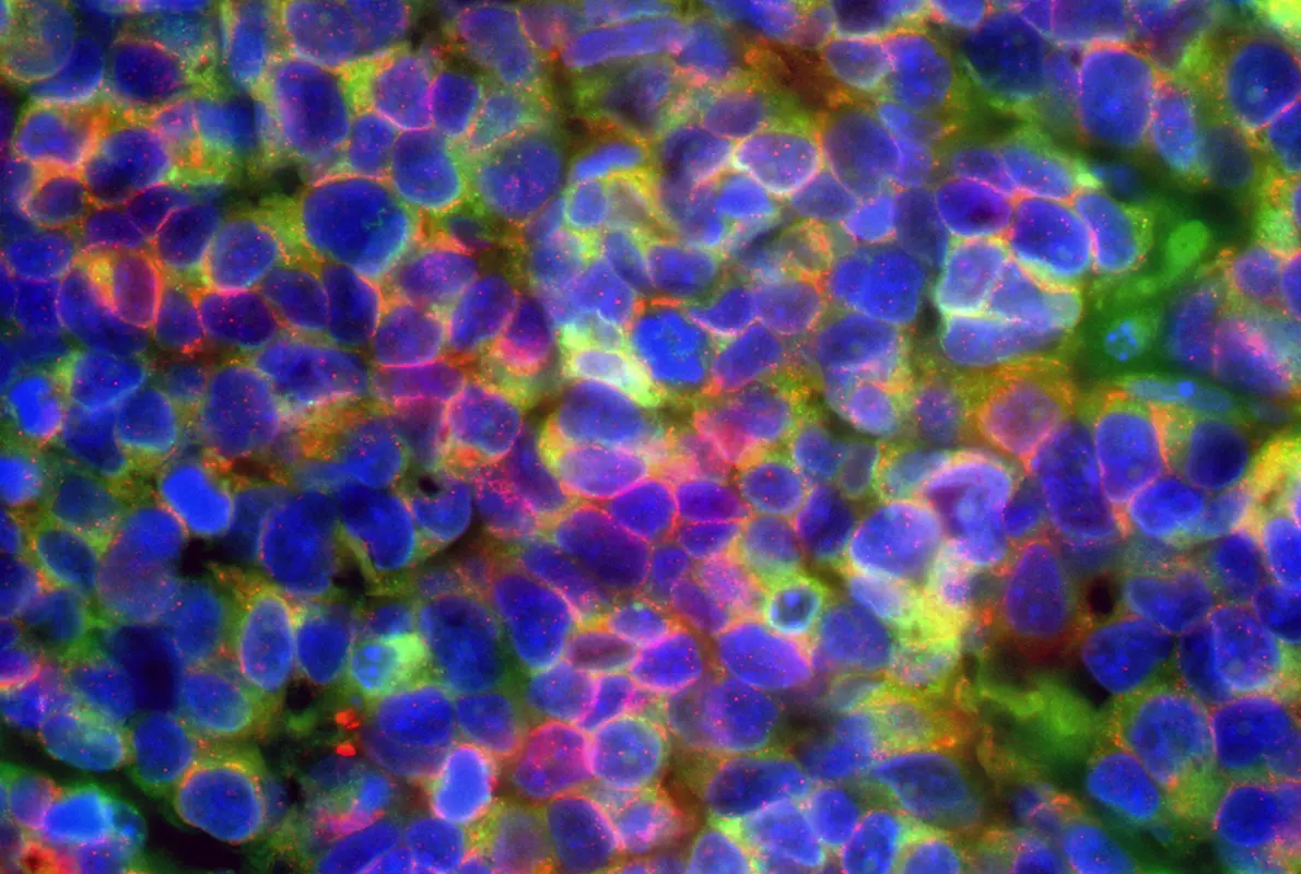 Microscopic image of small cell neuroendocrine prostate cancer, with cancer cells expressing diagnostic prostate cancer markers in green and red. Blue areas indicate cell nuclei. Image credit:Jung Wook Park and Owen Witte, UCLA.