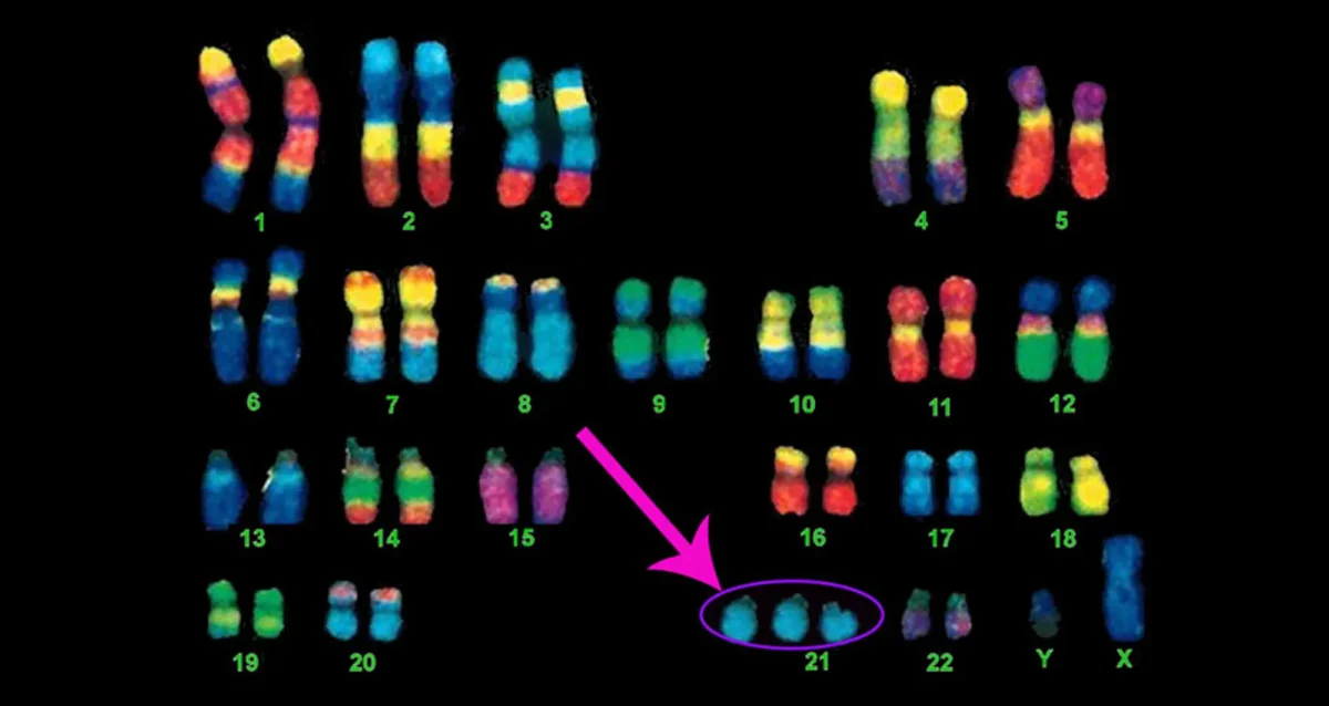 karyotype of chromosomes, three copies of chromosome 21 are indicated
