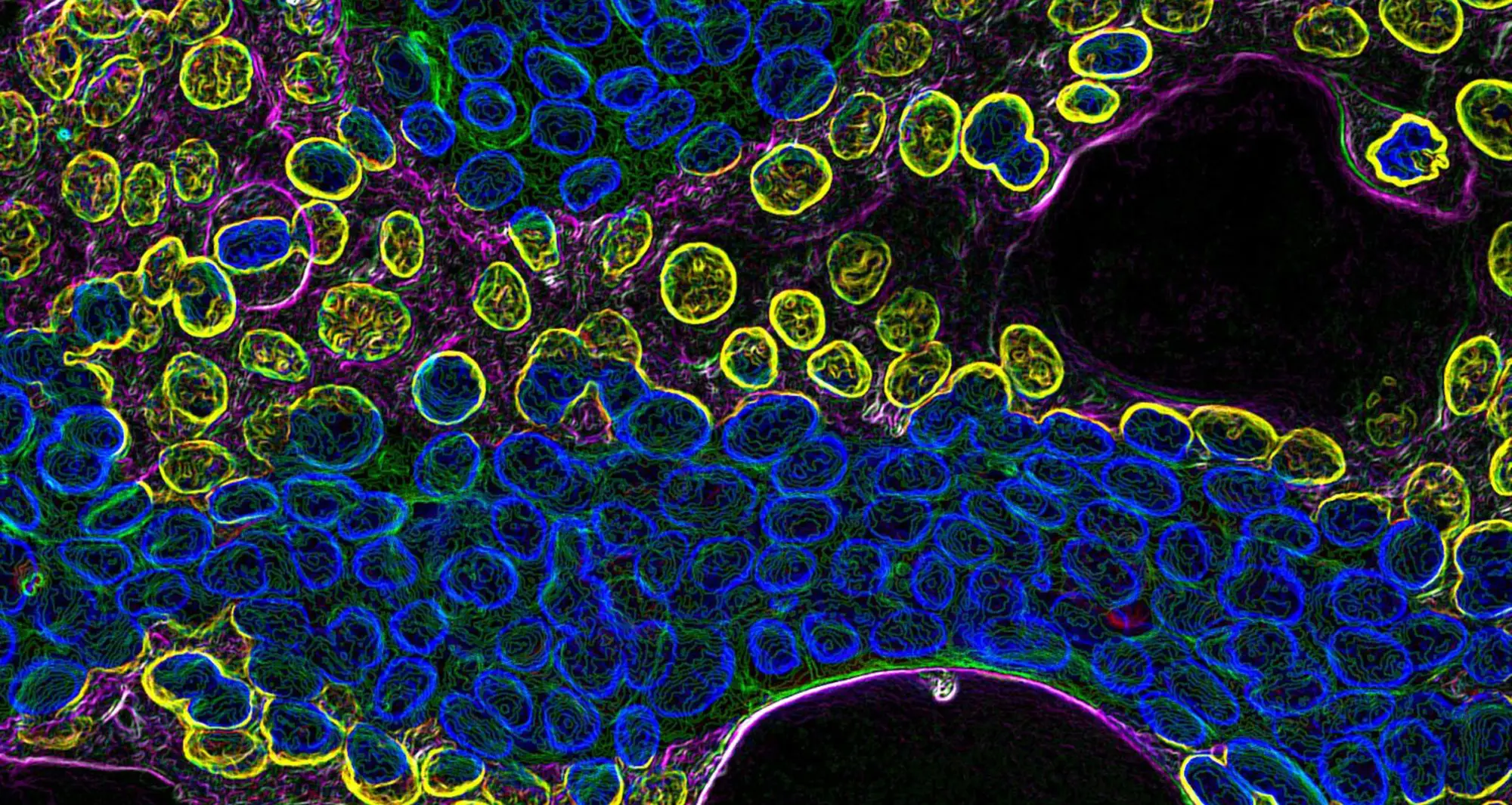 Carcinoma cells via fluorescence microscopy. Image courtesy of Frederick Keeney, The Wistar Institute, Philadelphia.