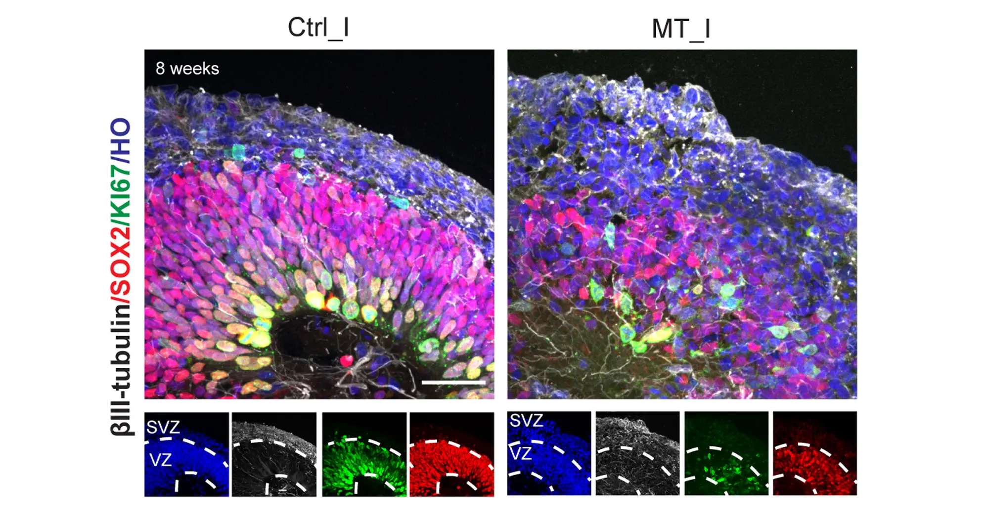 brain organoids derived from patients suffering from a newly discovered genetic disease had a more disorganized structure and fewer properly patterned developing nerve cells than healthy controls. Image credit: Fang Yuan, Su-Chun Zhang, Sanford Burnham Prebys.