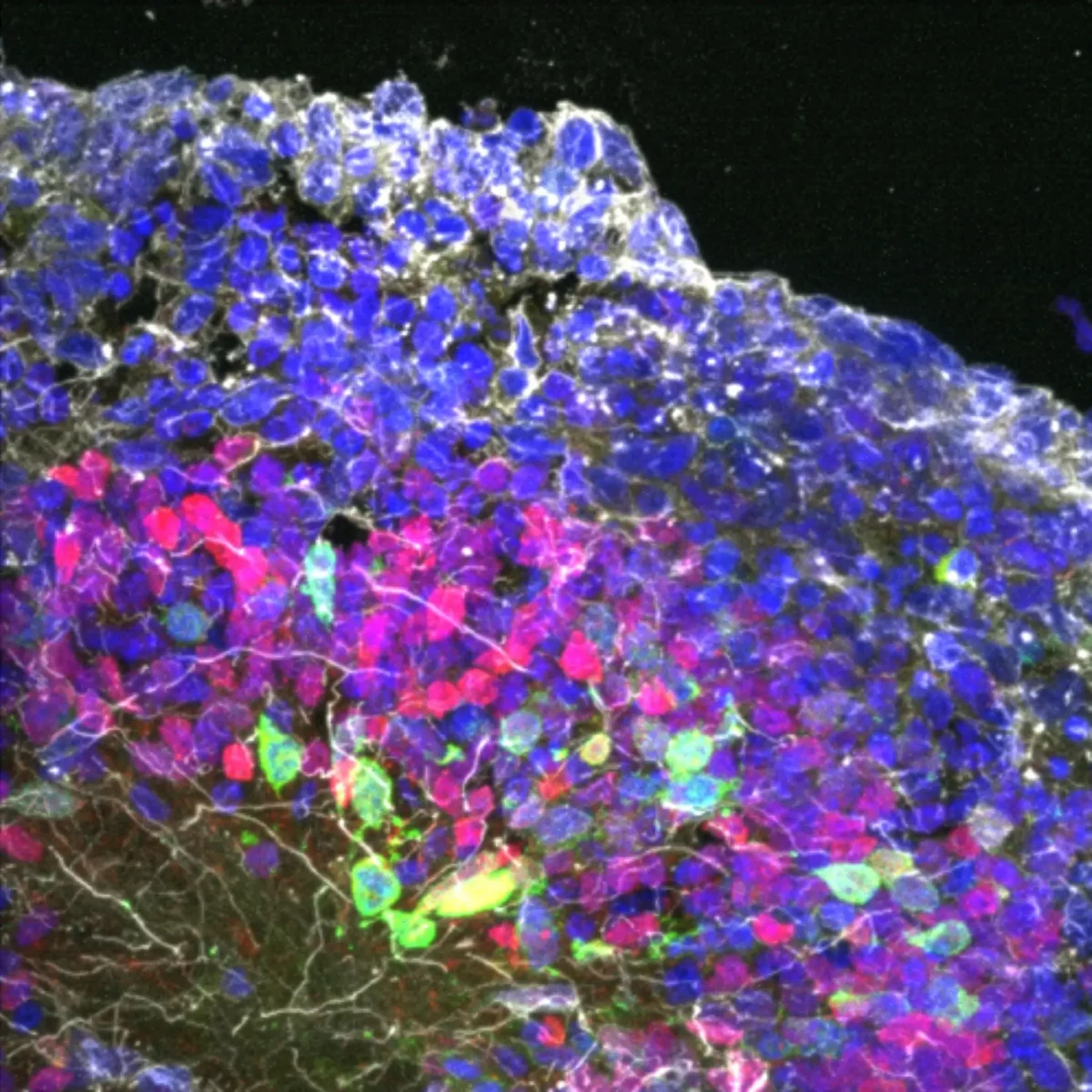 brain organoids derived from patients suffering from a newly discovered genetic disease had a more disorganized structure and fewer properly patterned developing nerve cells than healthy controls. Image credit: Fang Yuan, Su-Chun Zhang, Sanford Burnham Prebys.
