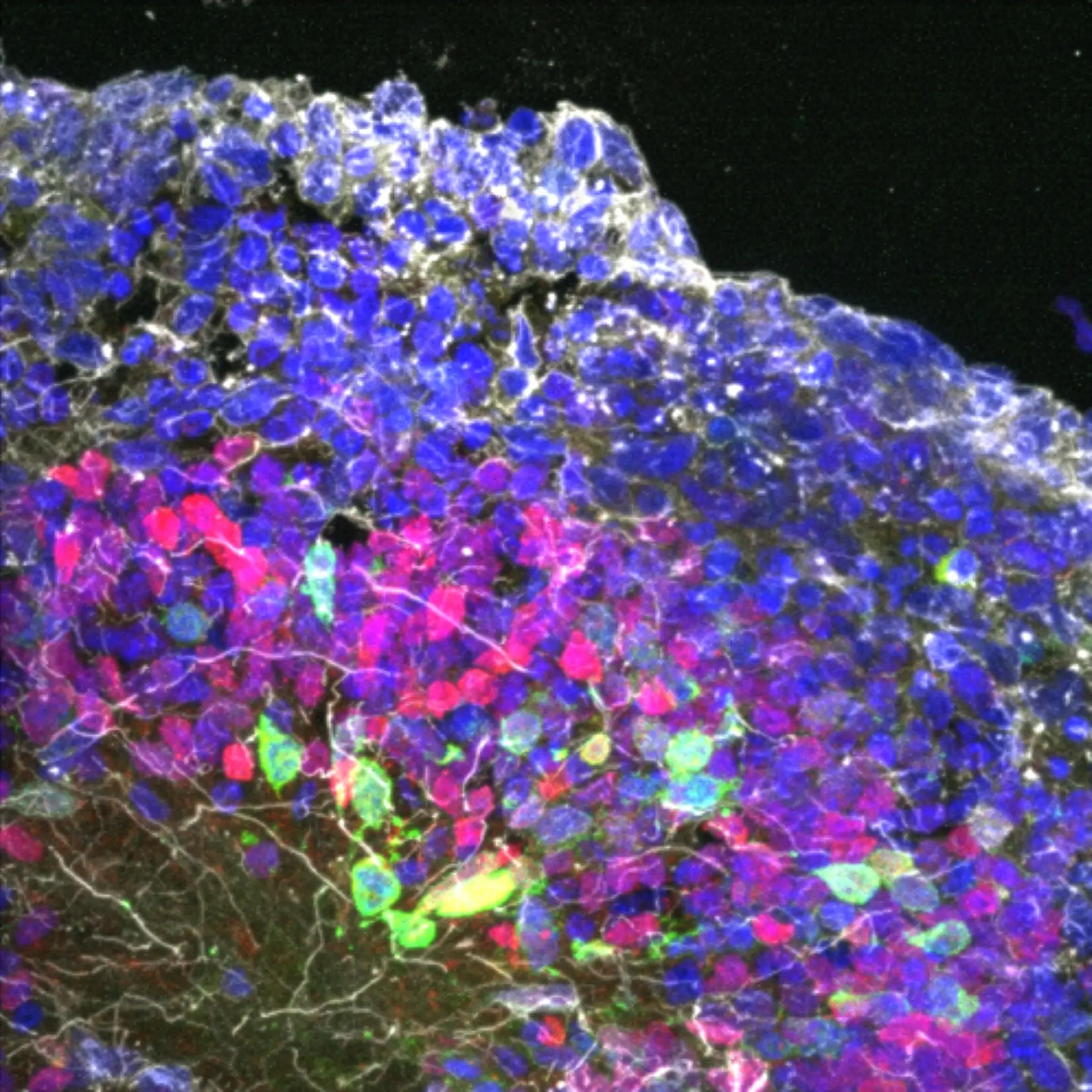 brain organoids derived from patients suffering from a newly discovered genetic disease had a more disorganized structure and fewer properly patterned developing nerve cells than healthy controls. Image credit: Fang Yuan, Su-Chun Zhang, Sanford Burnham Prebys.