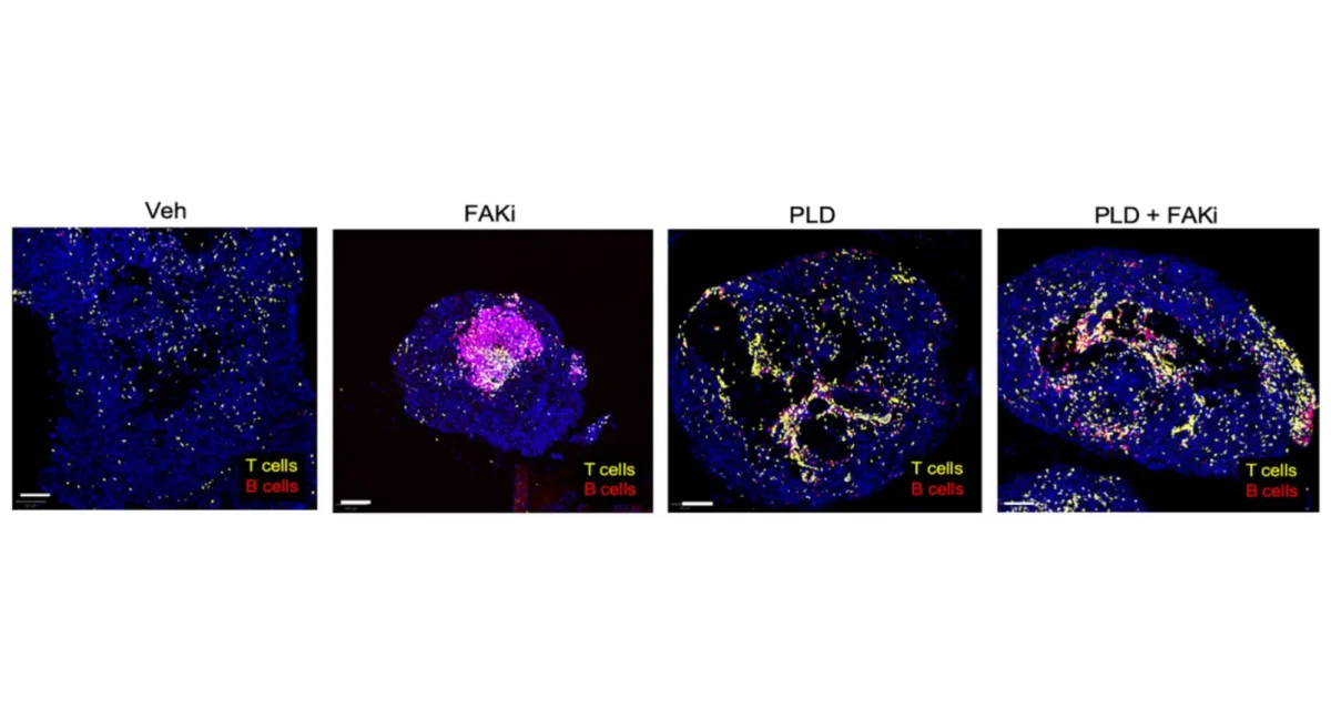 figure showing the results of treating an aggressive, chemotherapy-resistant ovarian mouse tumor model with an FAK inhibitor and/or a chemotherapy called Pegylated liposomal doxorubicin or PLD. Compared with untreated mice labeled as vehicle (Veh), the combined treatment led to controlled tumor growth while modifying the immune response to increase the infiltration of T and B cells. Image credit: David Schlaepfer, Kevin Tharp.