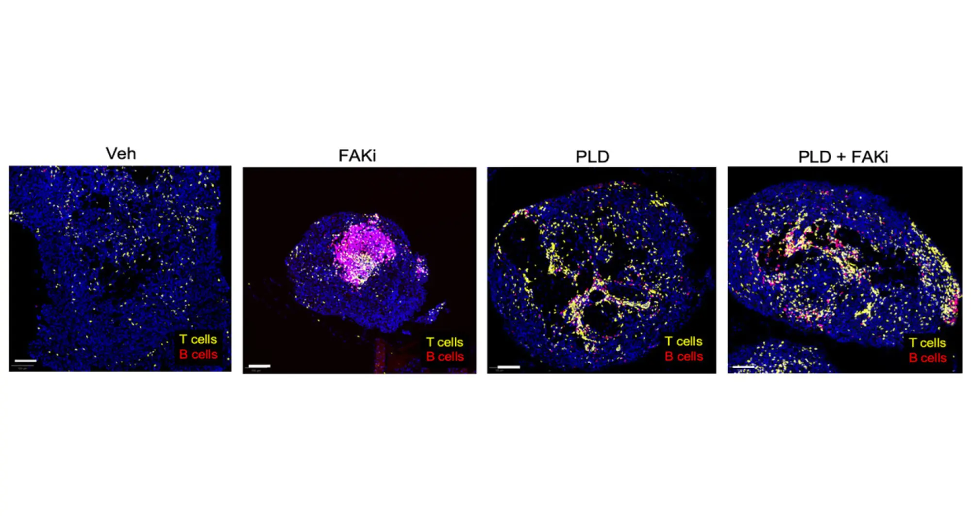 figure showing the results of treating an aggressive, chemotherapy-resistant ovarian mouse tumor model with an FAK inhibitor and/or a chemotherapy called Pegylated liposomal doxorubicin or PLD. Compared with untreated mice labeled as vehicle (Veh), the combined treatment led to controlled tumor growth while modifying the immune response to increase the infiltration of T and B cells. Image credit: David Schlaepfer, Kevin Tharp.