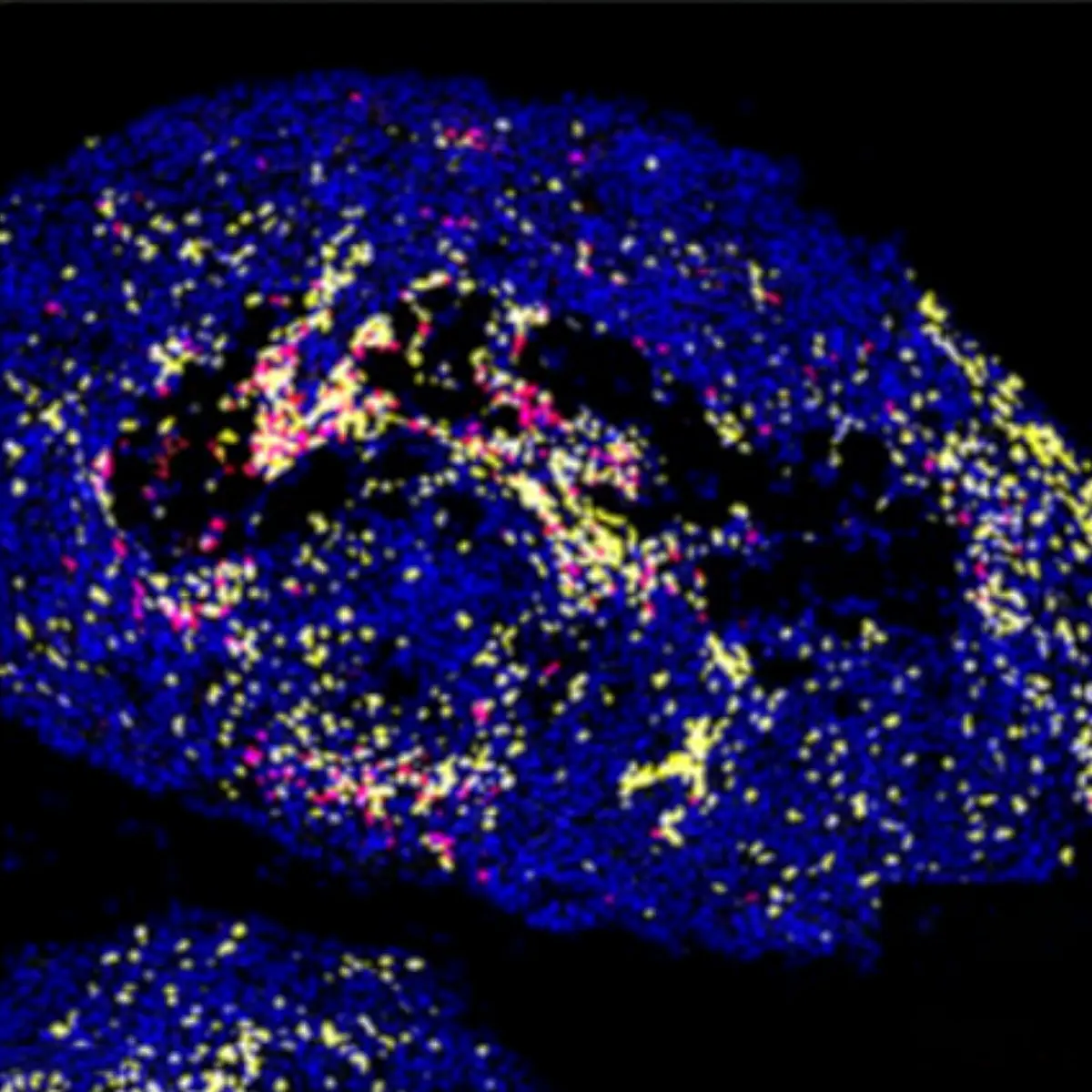 figure showing the results of treating an aggressive, chemotherapy-resistant ovarian mouse tumor model with an FAK inhibitor and/or a chemotherapy called Pegylated liposomal doxorubicin or PLD. Compared with untreated mice labeled as vehicle (Veh), the combined treatment led to controlled tumor growth while modifying the immune response to increase the infiltration of T and B cells. Image credit: David Schlaepfer, Kevin Tharp.