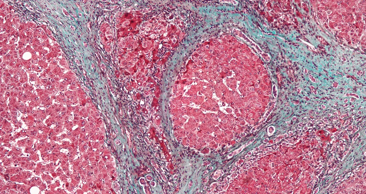 In this stained sample of liver tissue with cirrhosis, bands of fibrotic scarring are shown in blue.