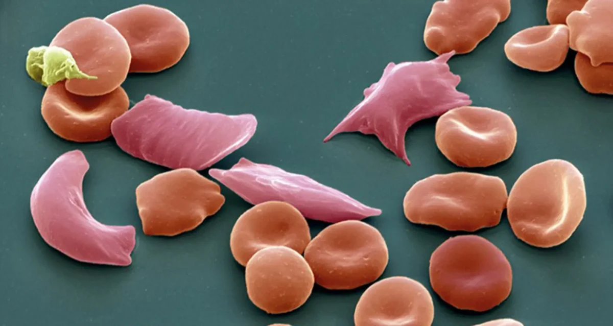 Colorized scanning electron micrograph depicts normal red blood cells (red, concave) with elongated blood cells indicative of sickle-cell disease (pink). Image courtesy of Eye of Science/SPL.