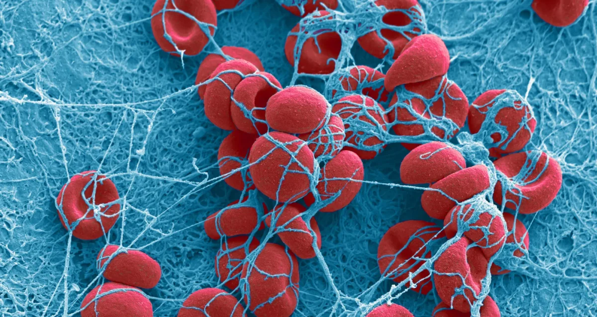 Colorized scanning electron micrograph of a blood clot