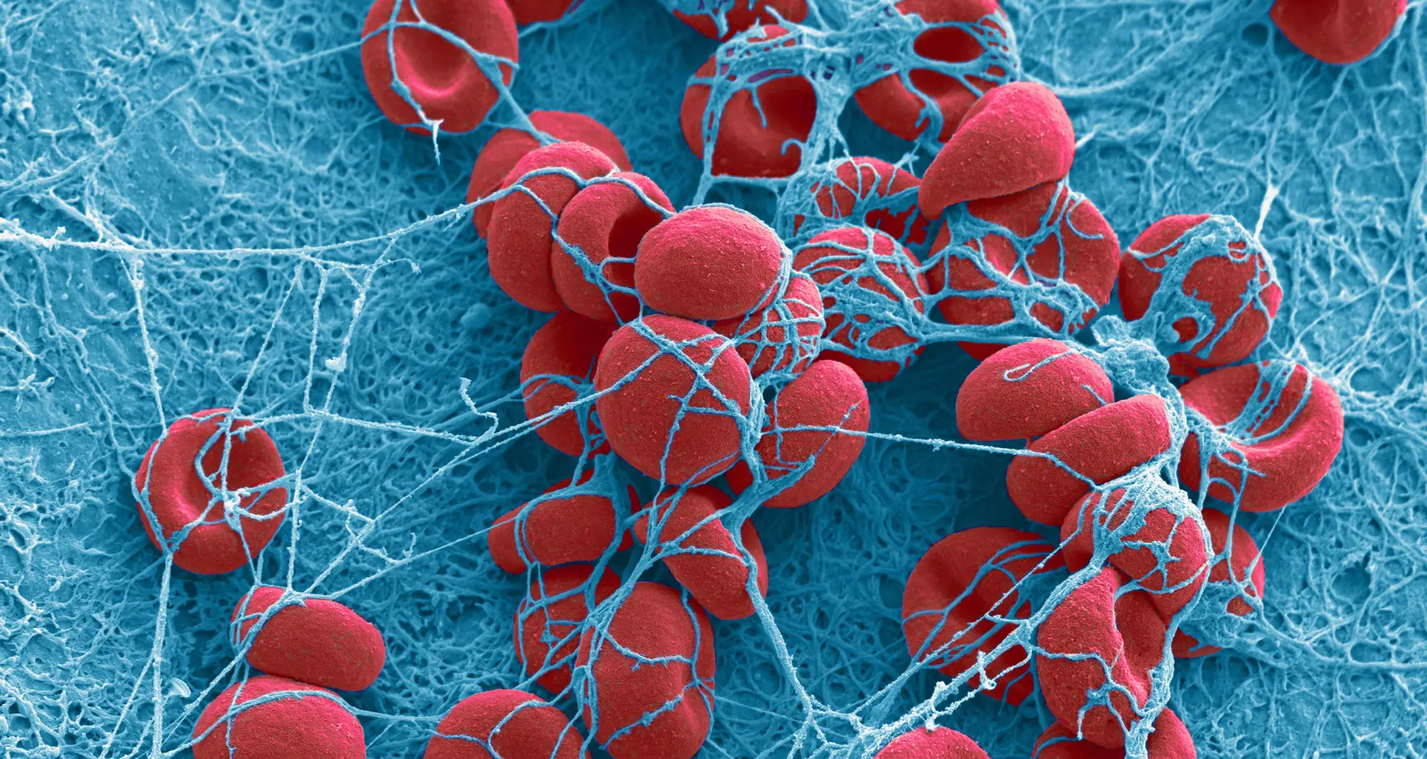 Colorized scanning electron micrograph of a blood clot