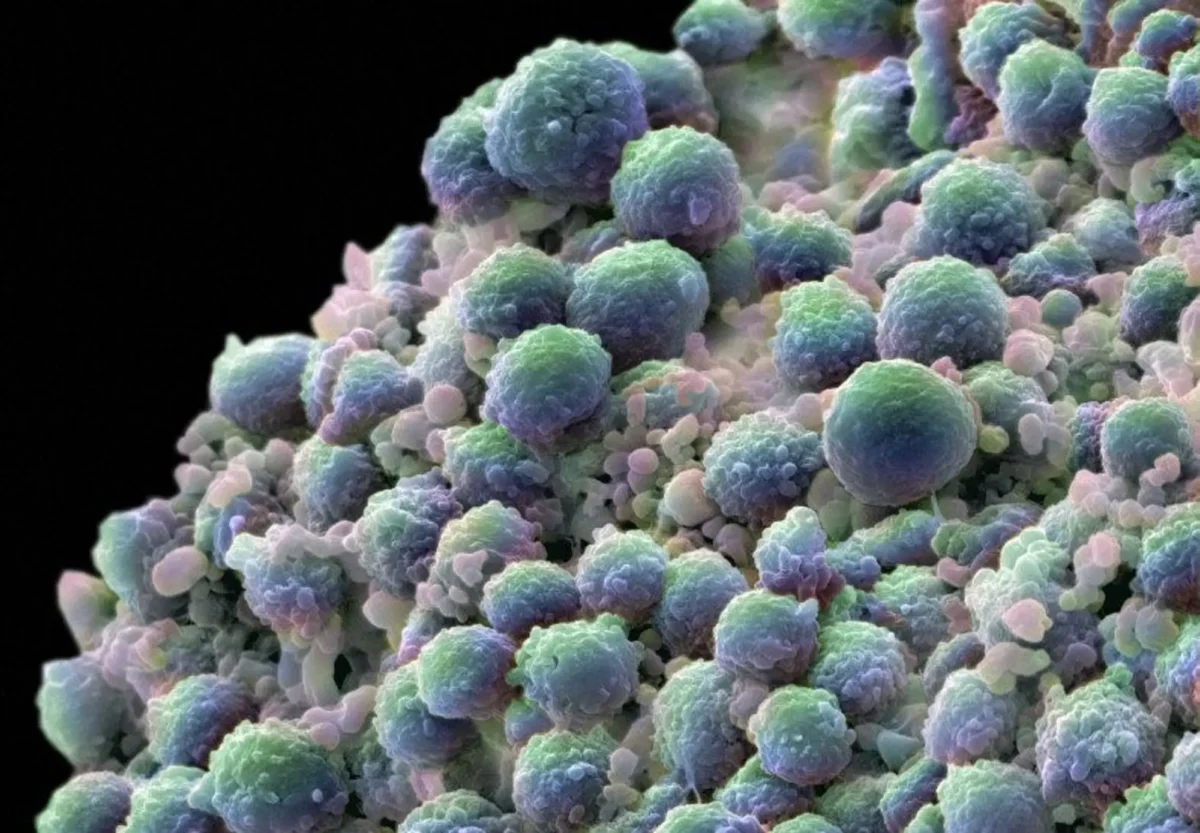 A colorized scanning electron micrograph depicts prostate cancer cells. Image courtesy of Wellcome Collection.