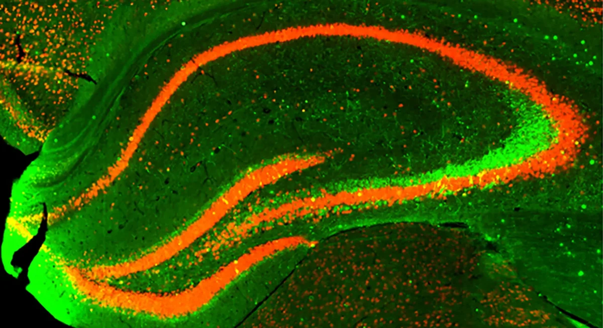 An overabundance of SORLA protein protects against a number of biological processes linked to the formation of tau tangles and progression of neurodegeneration. These include reducing the addition of too many phosphate groups to tau, known as hyperphosphorylation. In these biopsy images, less phosphorylated tau—stained to appear green—has accumulated in the bottom sample overexpressing SORLA. Image credit: Tim Huang, Huijie Huang, Sanford Burnham Prebys.
