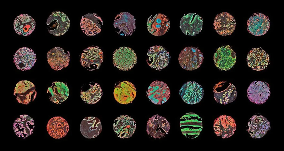 An array of human cancer tissues, including prostate, colon, kidney, intestine and breast, depicted in samples using fluorescence immunohistochemistry and confocal microscopy. Image courtesy of Wellcome Collection.