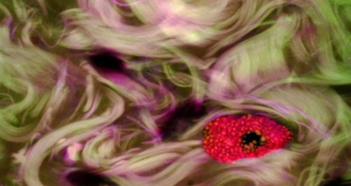 mast cell conjuctivitis. Image courtesy of Donald Pottle, The Schepens Eye Research Institute, Massachusetts.